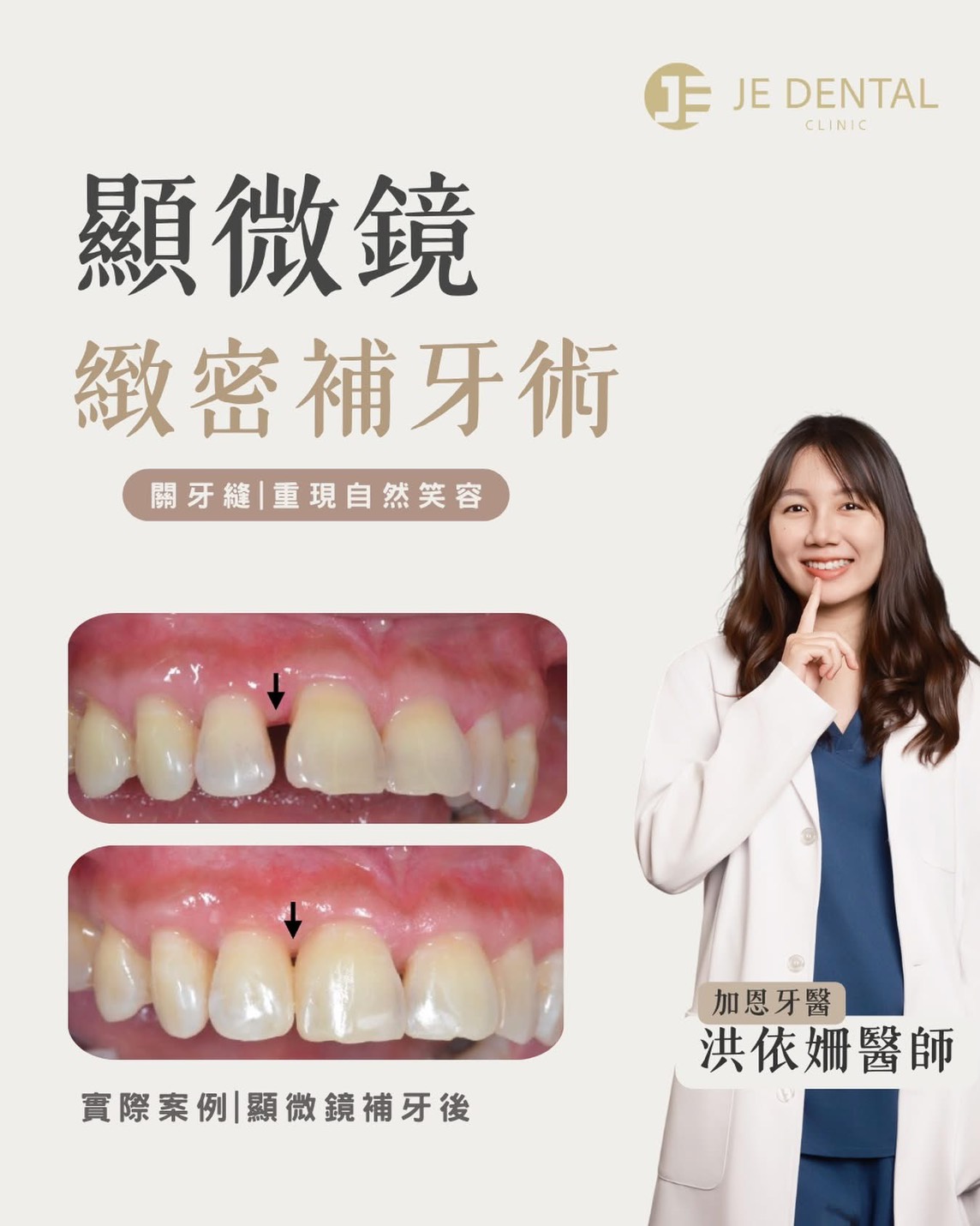 牙縫消失術
